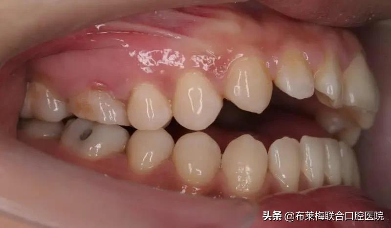 牙齿矫正,你所关心的那些问题