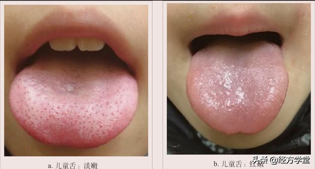 「经方学堂」,一起学习舌诊,教您如何看舌象的正常与异常