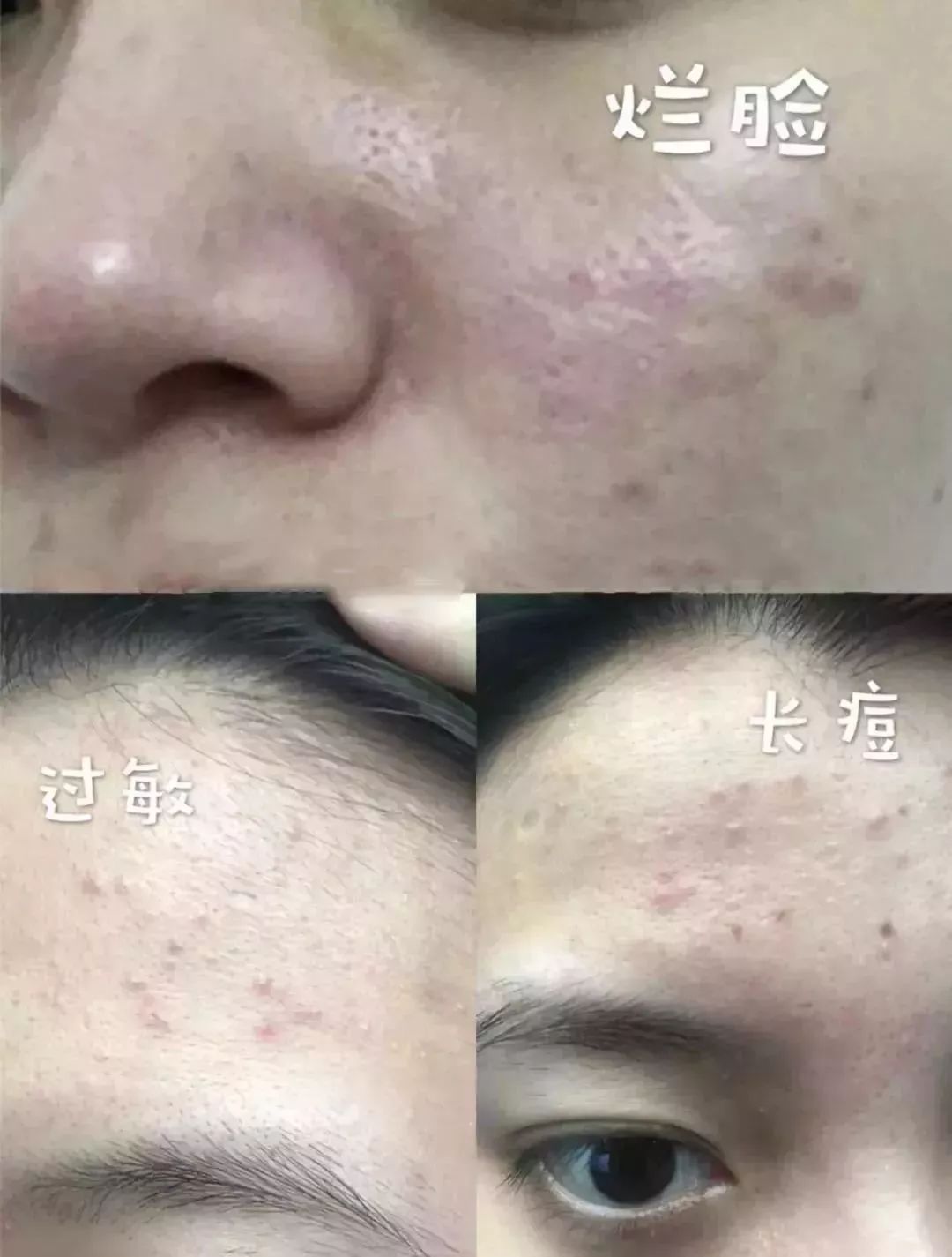 脸上泛红发痒、出油长痘？“螨虫脸”真的很丑，除螨刻不容缓