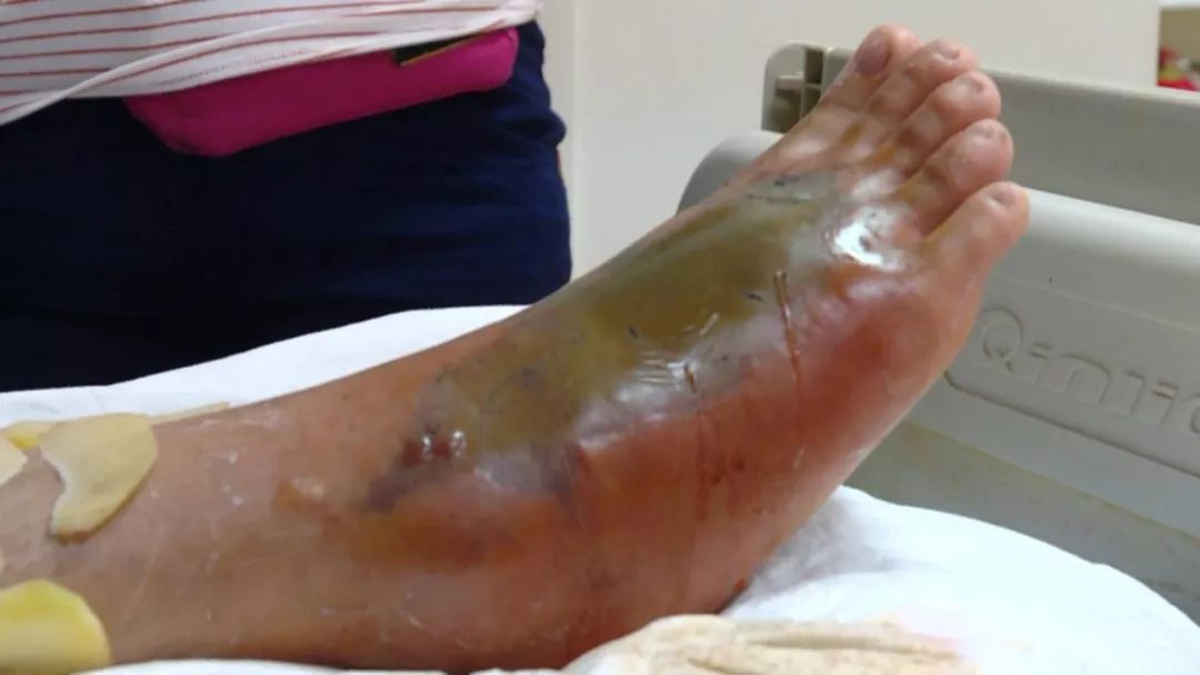 广东3岁男童被竹叶青咬伤!有多毒?比五步蛇还强20倍