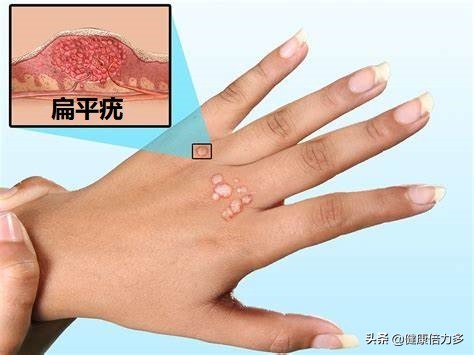 hpv感染引起的扁平疣hpv主要通过直接接触、间接接触以及性传播引起感染。