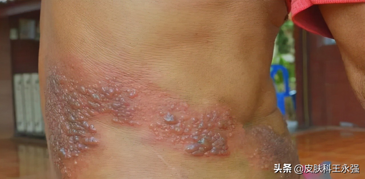 "缠腰蛇"带状疱疹剧痛难忍,该怎么治?