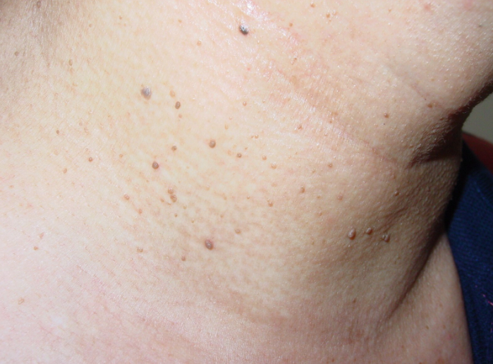 腋窝及颈部出现肉疙瘩的原因分析