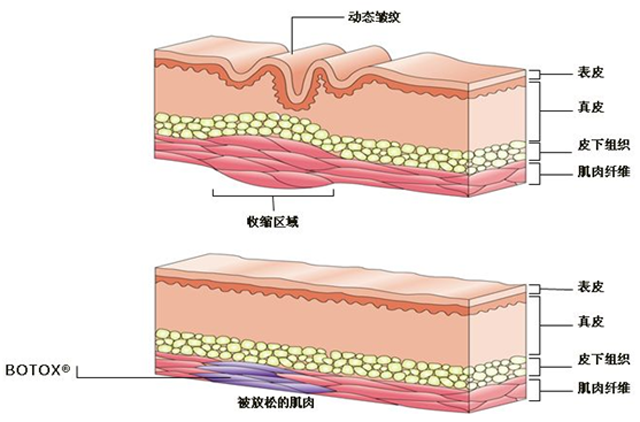 注射、线雕、拉皮、超声刀怎么选？| 北大教授张宗学