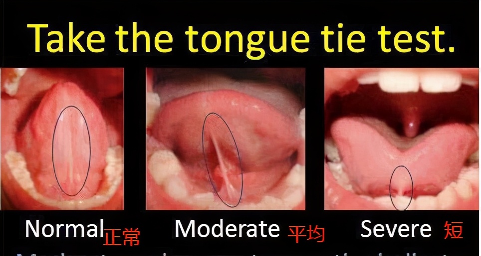 宝宝喝水“嘴漏”、咬字不清？快看是 不是舌头被「锁住」了