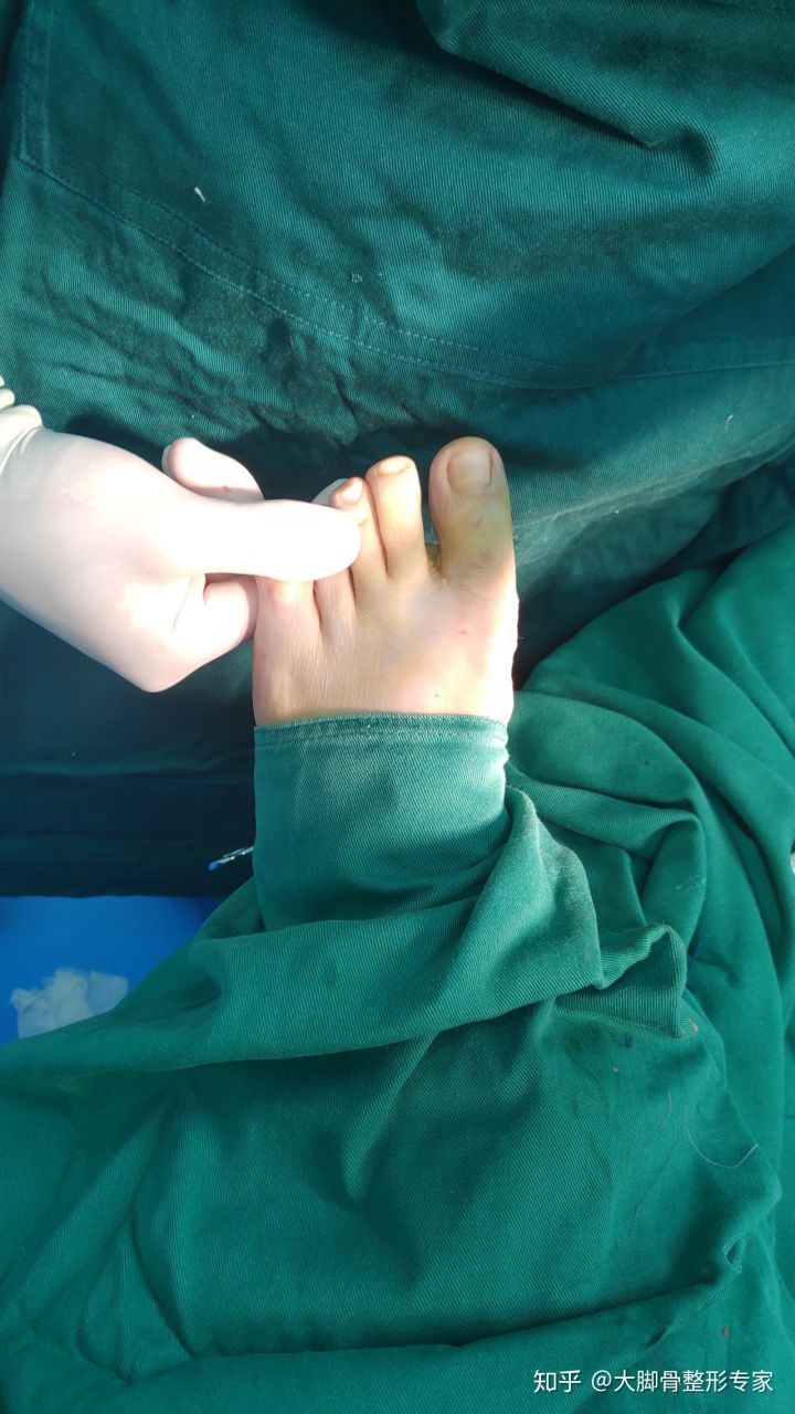 大脚骨朋友问：我这算什么程度的大脚骨啊？且看案例