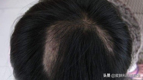 一块一块脱发太可怕，斑秃该如何治疗？