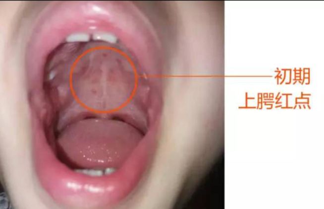 孩子春夏季节高烧、喉咙痛不肯吃东西？多半疱疹性咽峡炎惹的祸！