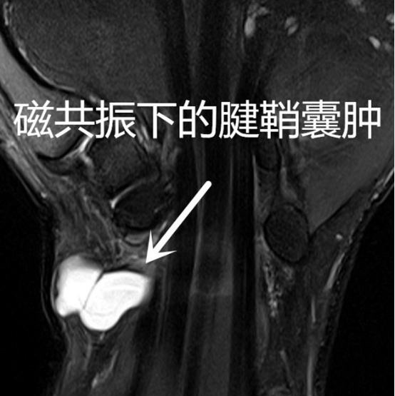 腱鞘囊肿—手部包块最常见疾病！不是一定要手术！如何治疗、预防