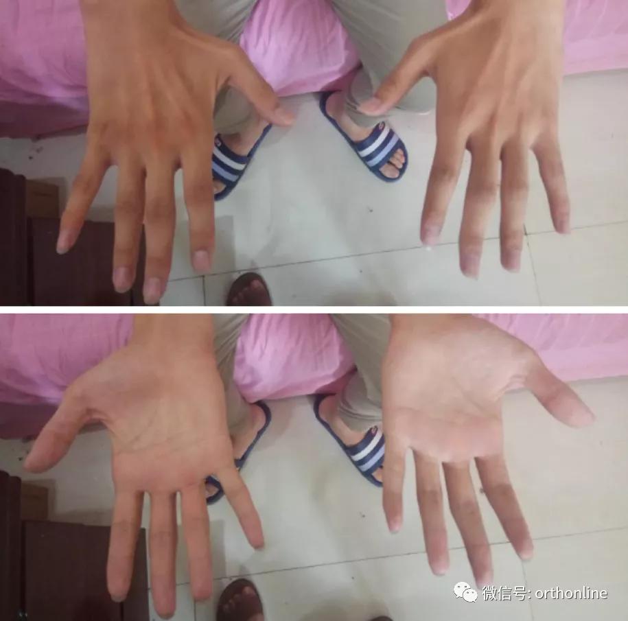 17岁少年手无力肌萎缩,小心罕见"平山病"