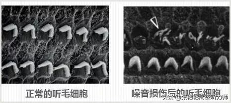 哪些听力损失是暂时，可恢复的？