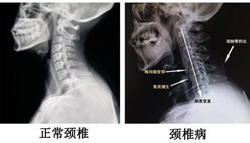 案例分享，头晕伴颈肩背部疼痛该如何诊治？