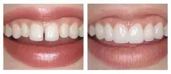 天啊！牙齿缝隙越来越大怎么办？