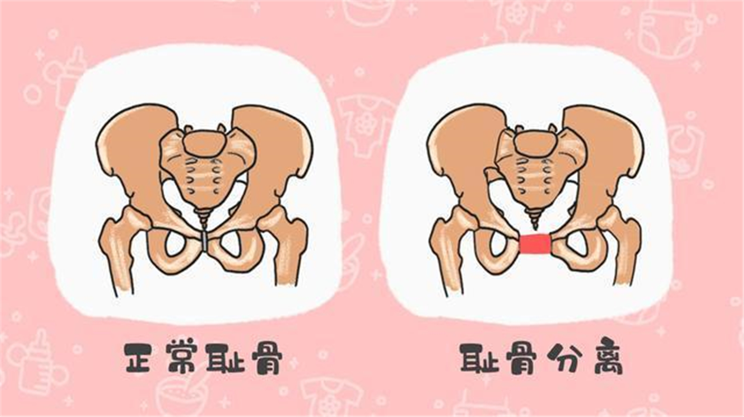 孕期"耻骨"痛到厌世?五类孕妇更易中招,缓解疼痛有妙招