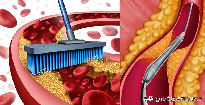 突发脑梗死，黄金救援3-6小时，要怎么应对？一文告知您