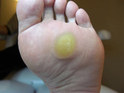 脚上长的是鸡眼、瘊子，还是老茧，你搞清楚了吗？