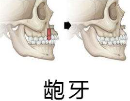 严重龅牙不仅影响美观，更影响咬合引发各种问题，牙医教你怎么治