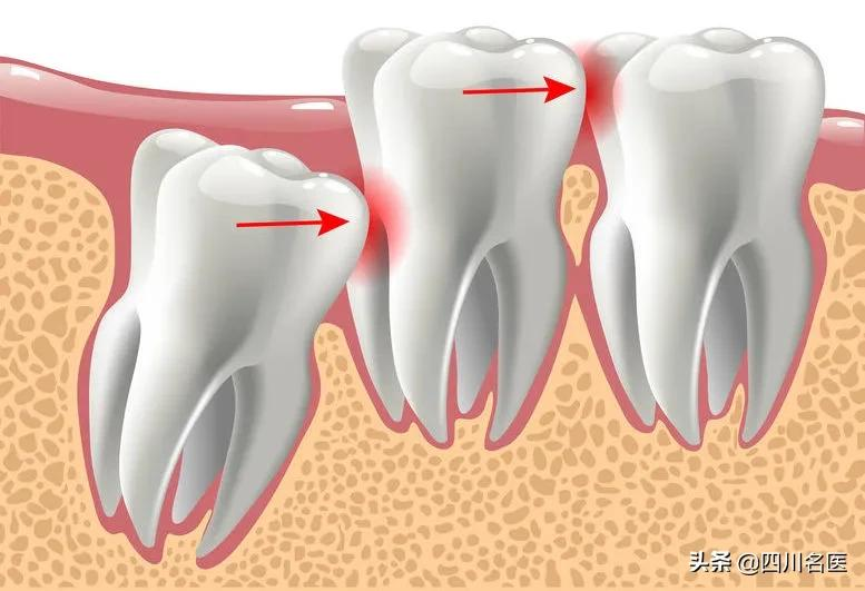 智齿到底要不要拔？一次拔几颗？什么时候拔？终于讲清楚了