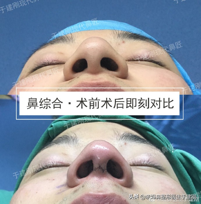 男生隆鼻术后效果怎么样？来看看“鹰钩鼻”小伙耳软骨隆鼻后效果