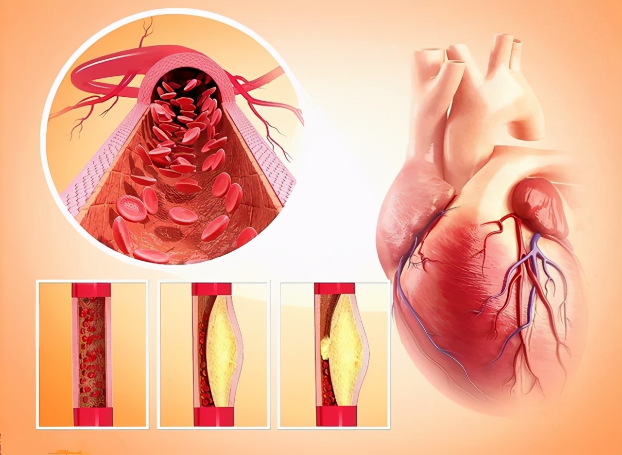 得了冠心病，整天担惊受怕的，就怕心梗猝死，该怎么办