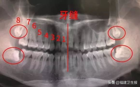 晚了一年拔智齿，福建女子可能多花1万！医生：这5种智齿不拔，就是烧钱的无底洞