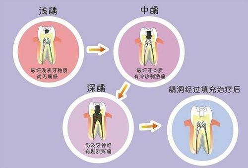 牙齿烂了之后，补牙后医生建议要戴牙冠，真的有必要吗？