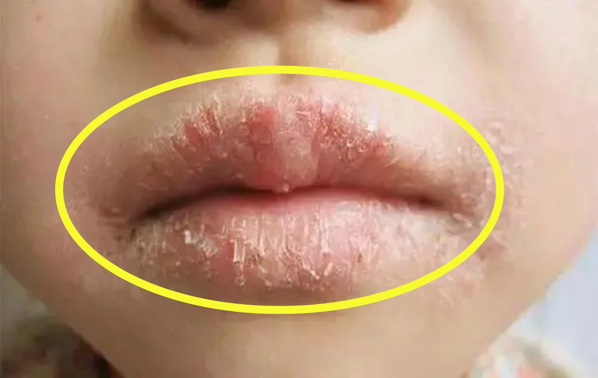 孩子嘴唇干裂、起皮还出血怎么办？医生教你正确护理，比喝水管用
