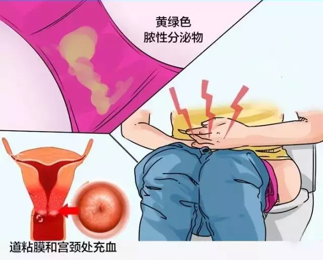 滴虫性阴道炎是身体里有虫子吗?