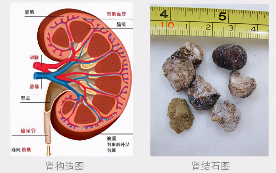 体检查出肾结石，别慌：3个方法，或能让肾结石离开身体