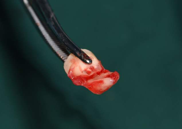 牙根还会再长出来吗?