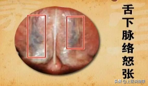 中医：有这1种舌象的人，当心癌症找上门！建议尽快做检查