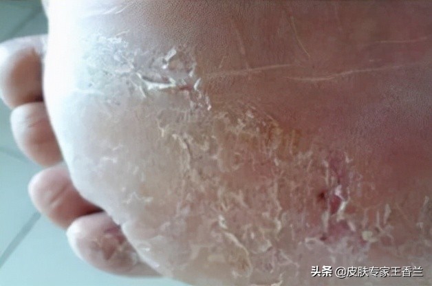 脚癣反复发作？可能是你用错了方法