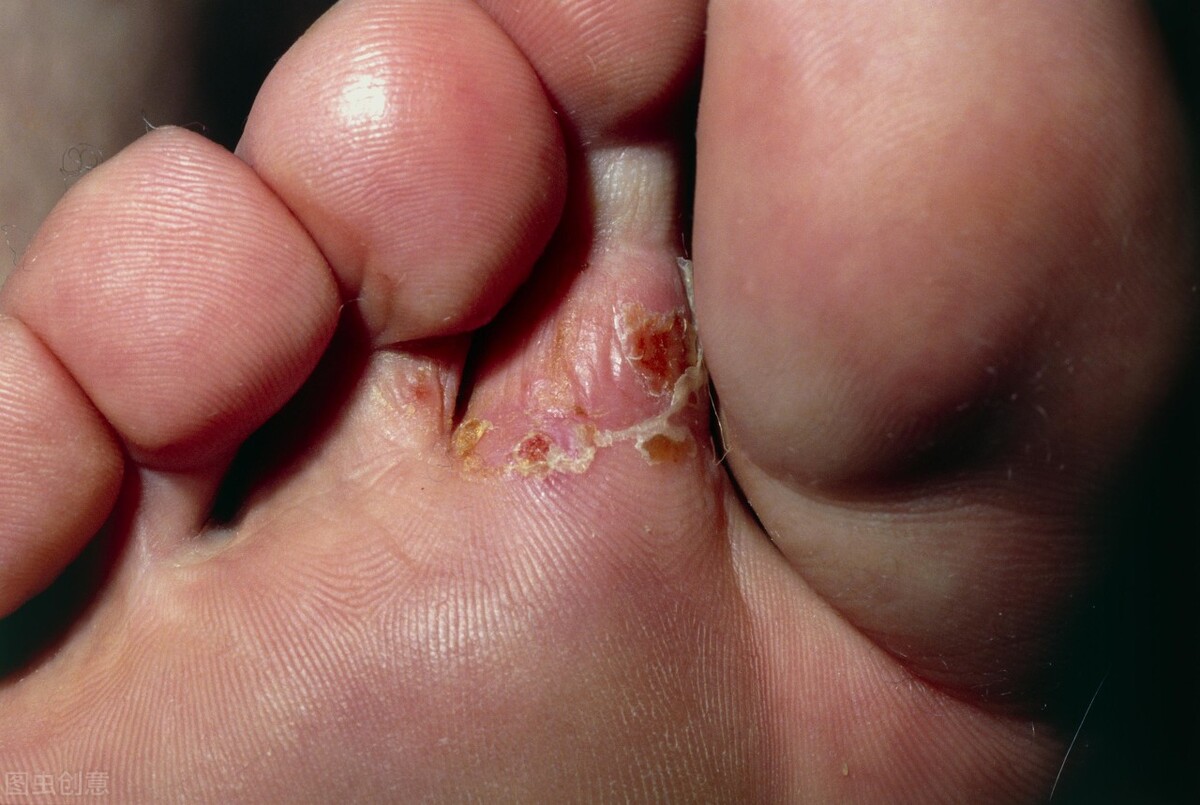 宫颈糜烂死皮脱落图片(医生教你怎么治理香港脚) - 赤虎壹号