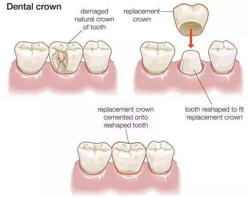 牙齿烂了之后，补牙后医生建议要戴牙冠，真的有必要吗？