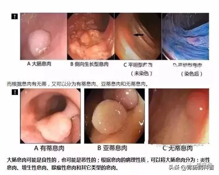 小息肉吓到大总统——为切除交权2小时！肠息肉到底有多危险？