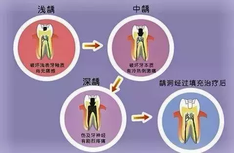 补牙要趁早!小龋坏久拖不治,最后花费上万,冤不冤?