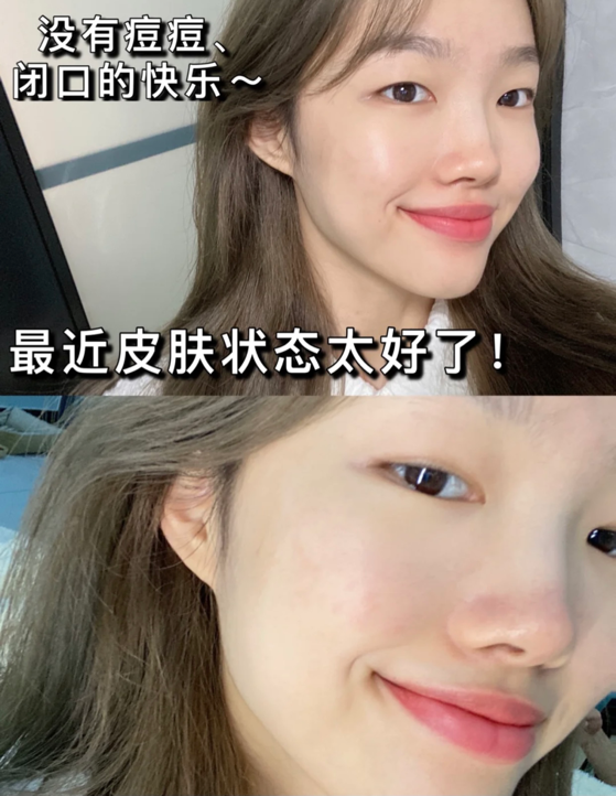 悦木之源适合油痘肌(悦木之源适合油痘肌吗)