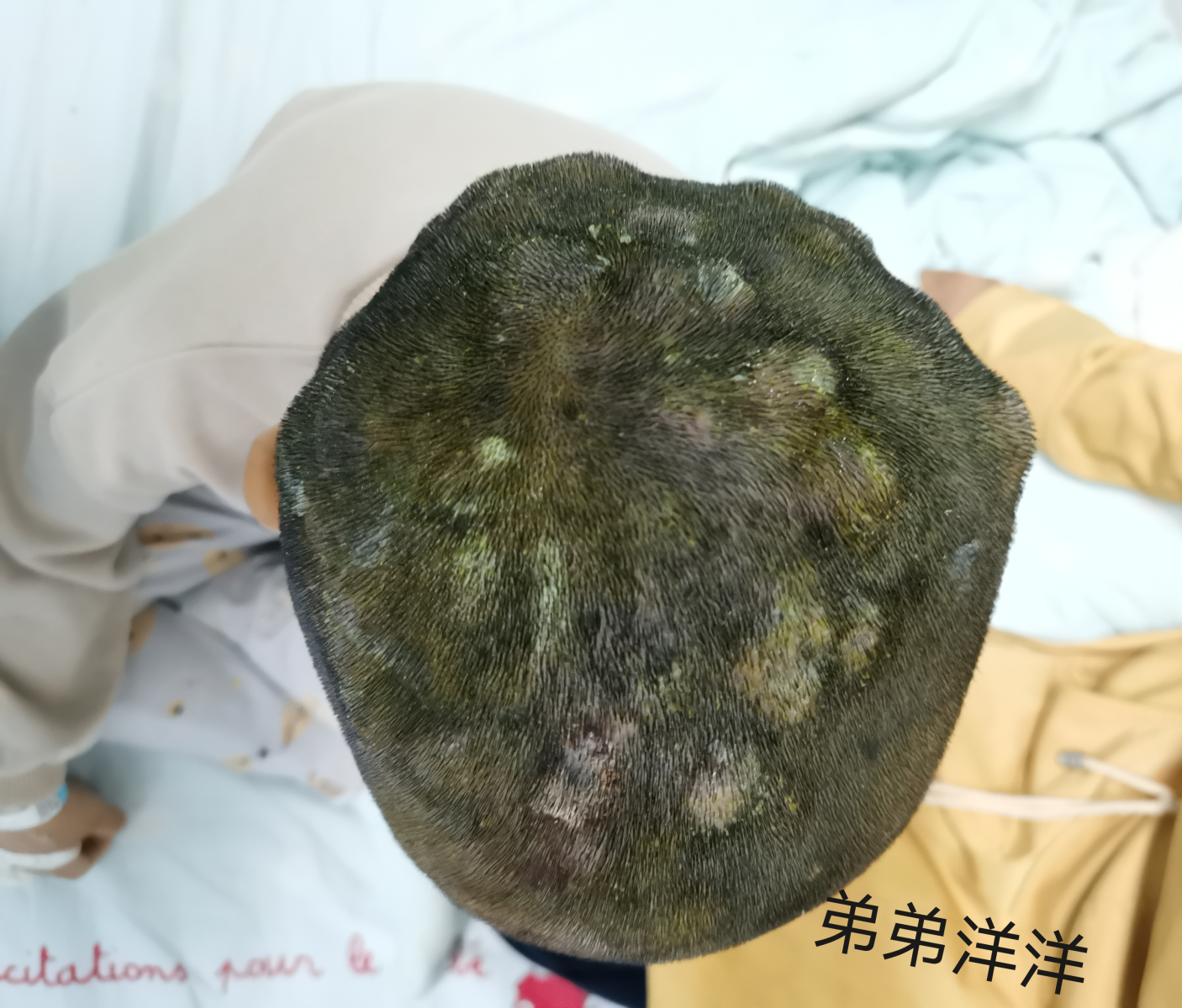 头皮发麻！姐弟俩先后因脓癣入院，问题竟出在家里来的“新成员”