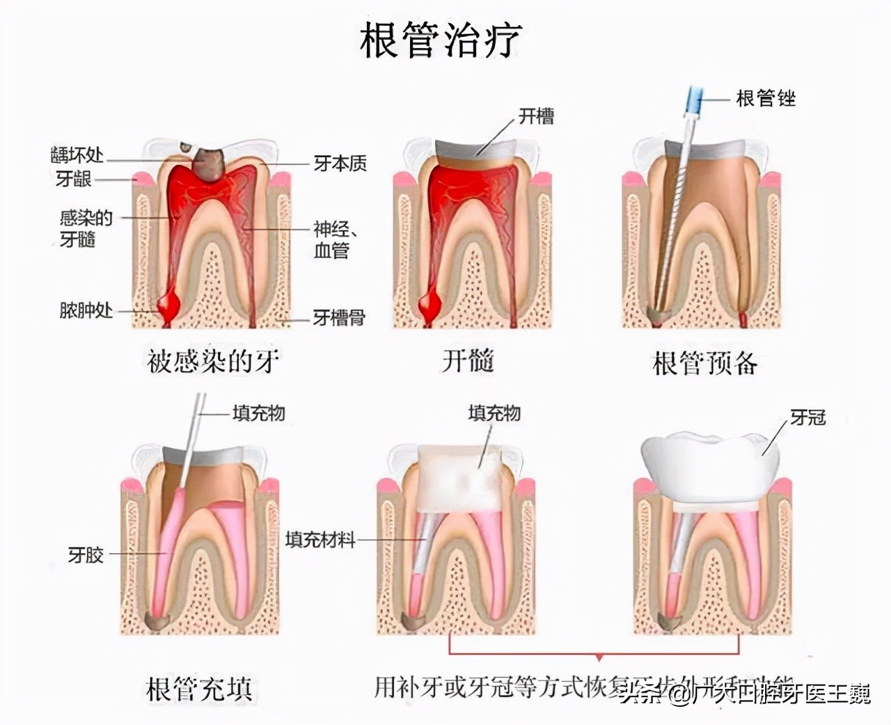 专家提醒：七成牙齿松动不需要拔除！正确做法应该是