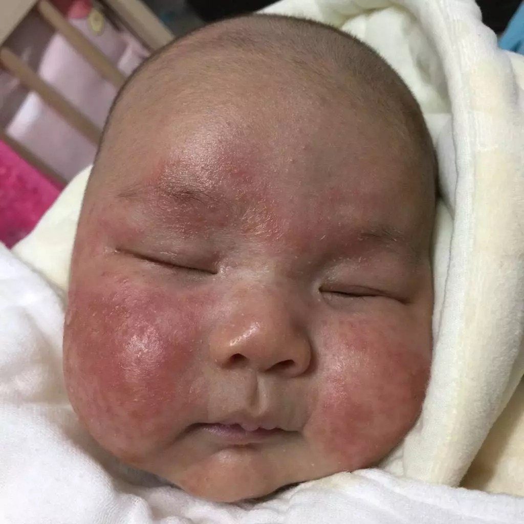 婴儿脸上有湿疹照片摄影图片_ID:141008515-Veer图库