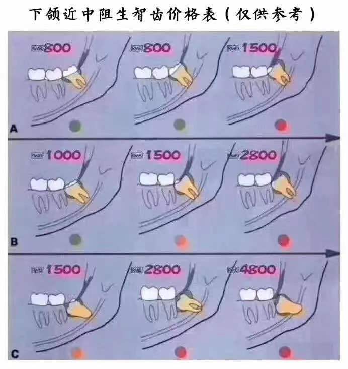 患者说为什么他拔智齿我要收1300，而他的朋友只要400元？