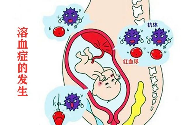 夫妻“血型不合”有什么影响？其中的危险很少人知道，你别不重视