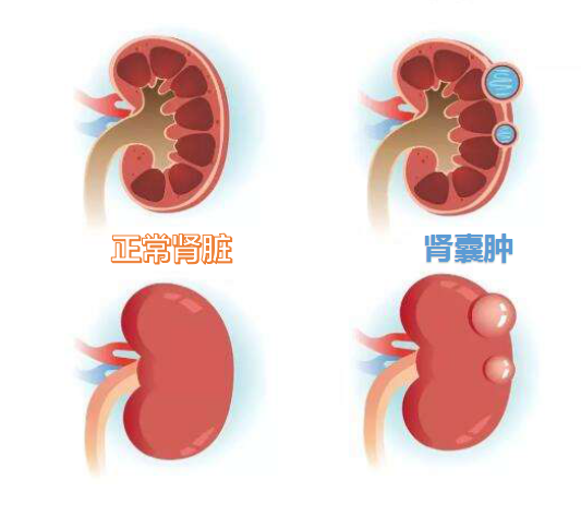 体检发现肾囊肿怎么办?医生告诉你最佳的应对方法