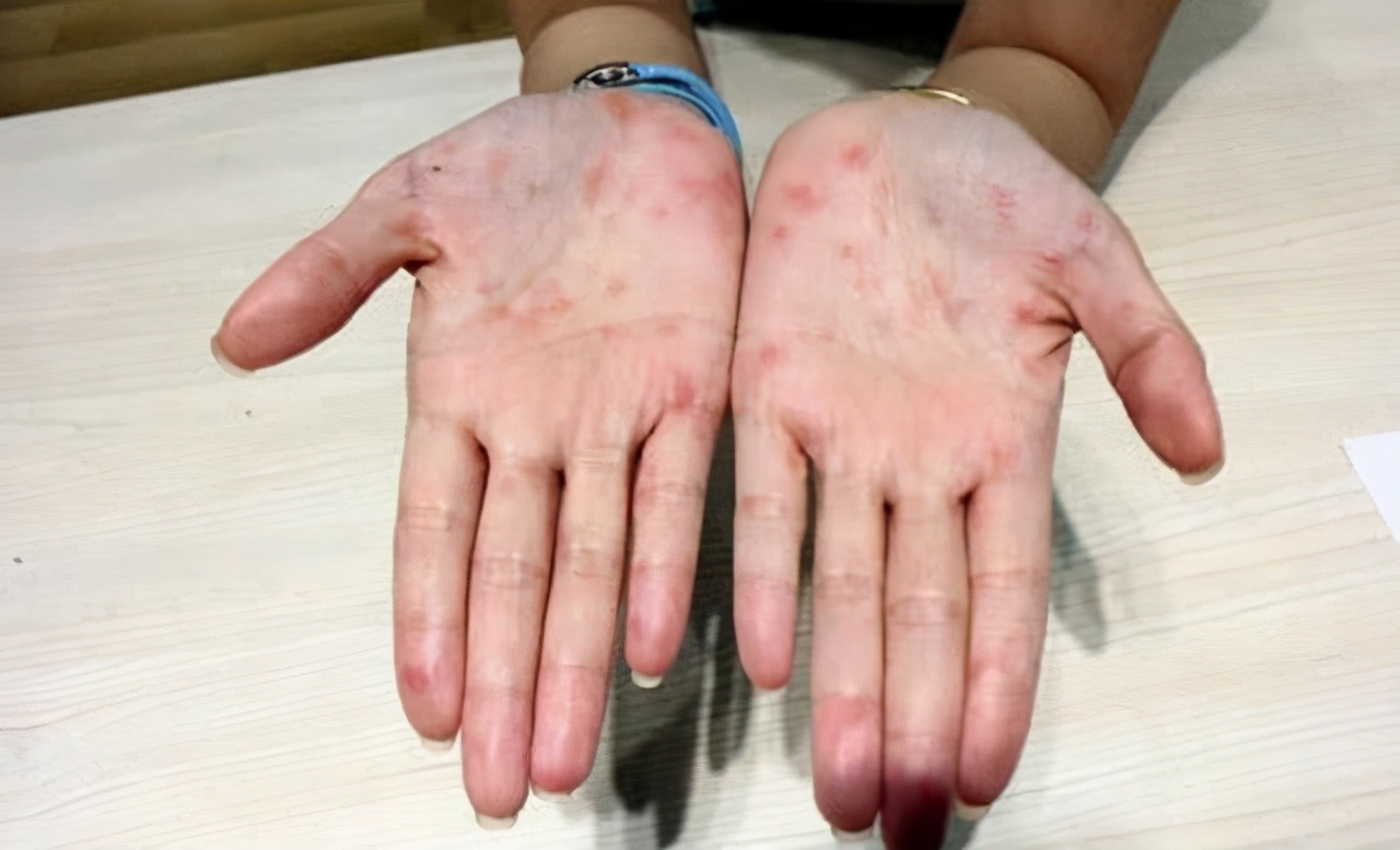 梅毒会表现出哪些症状和体征呢?