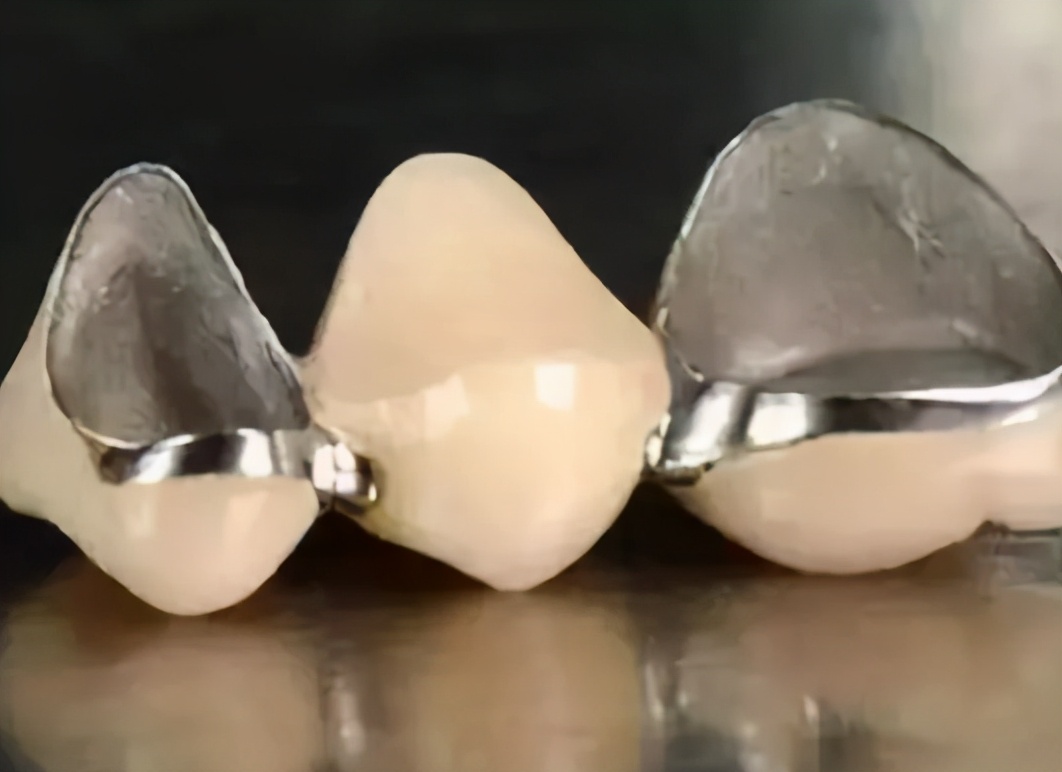 全瓷牙牙套多少钱一颗全瓷牙比烤瓷牙贵那么多