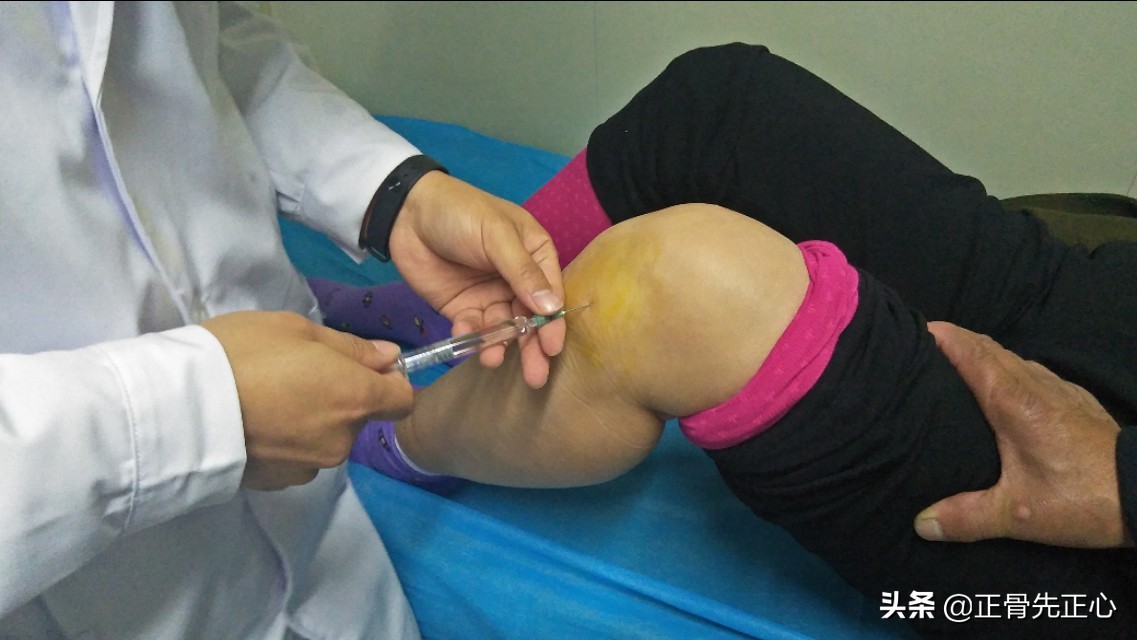 玻璃酸钠关节腔注射能够缓解膝关节疼痛吗?