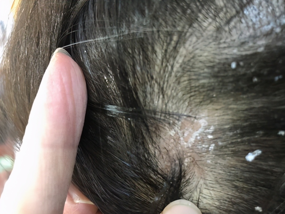 女性头皮真菌感染图片(头上摸到的小疙瘩到底是什么) - 赤虎壹号