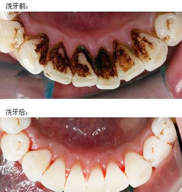 洁牙后,牙齿出现黑斑,是蛀牙了吗?再也不去洁牙了
