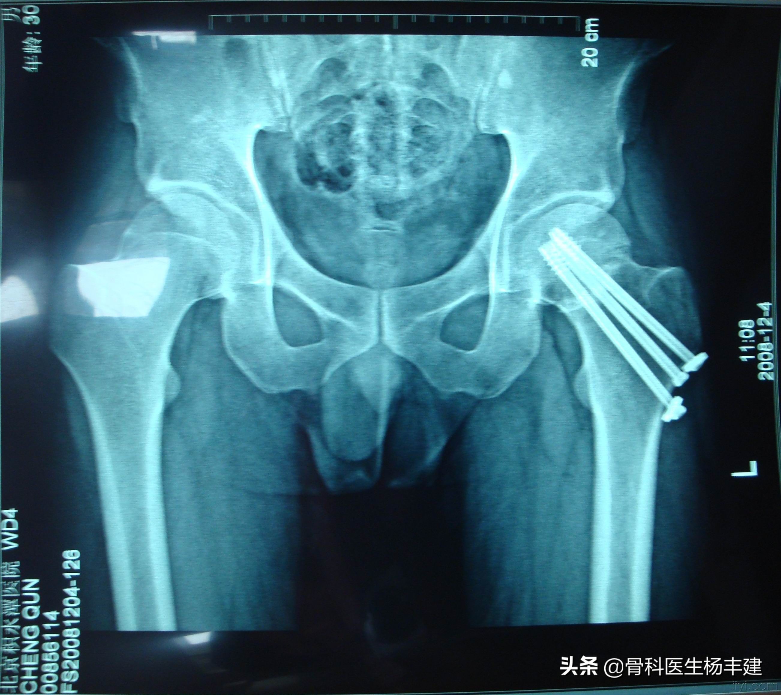 骨折手术愈合后，钢板拆还是不拆？你要的问题答案在这里