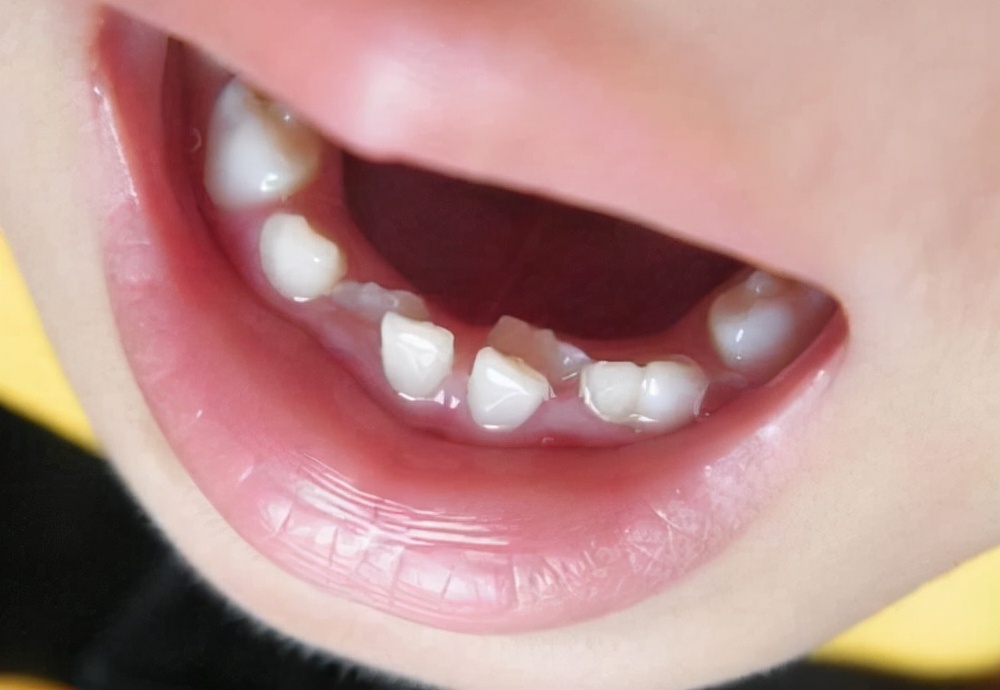 小孩换牙迟缓怎么办？长期不换牙可能影响口腔健康发育